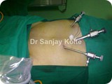lap repair of incisional herniak